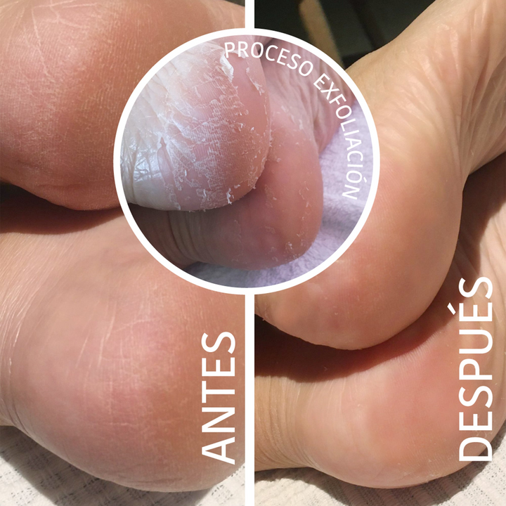 Calcetines Exfoliantes y Peeling con Ácido Glicólico
